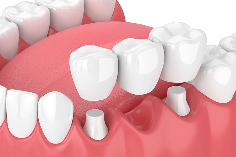 Dental Bridges in Van Wert