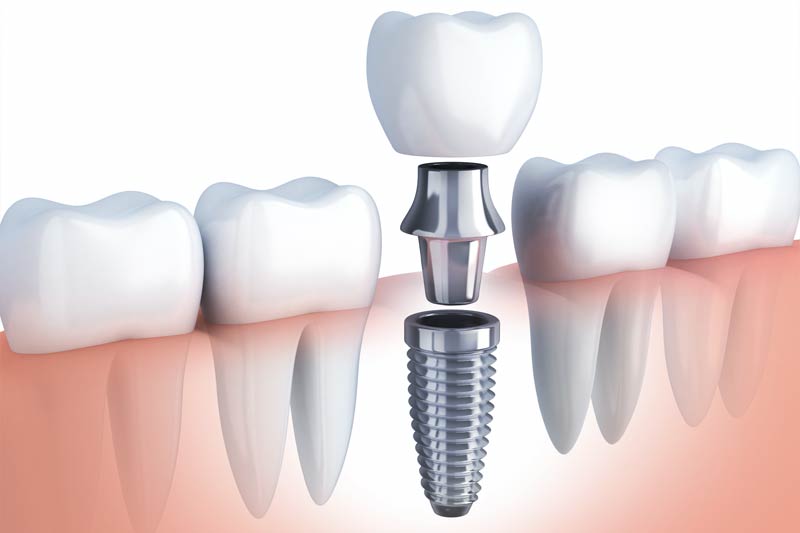 Implants Dentist in Van Wert