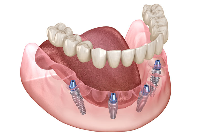 Implants Dentist in Van Wert